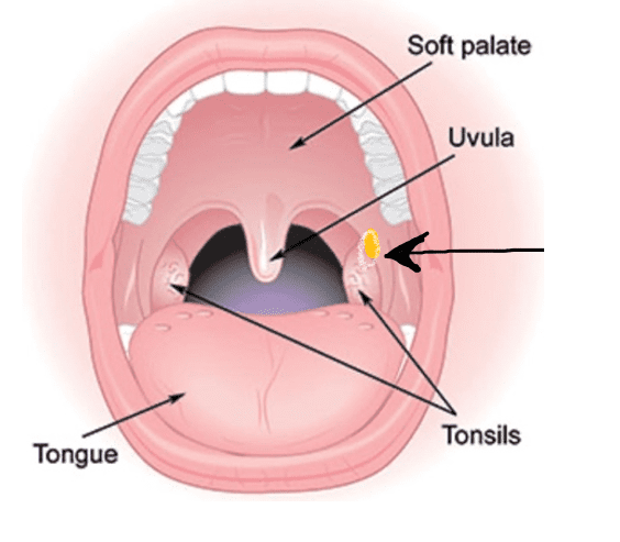 ulcer on tonsil