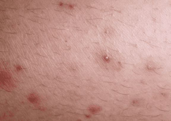 Skin Infections Causes Symptoms And Treatment