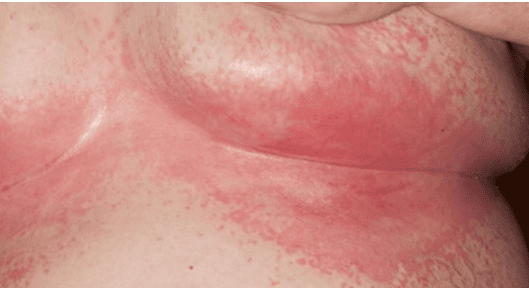 Common Acute Rashes in Urgent Care Setting - Medical Care One